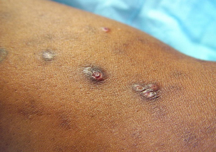 Nhiễm nấm sâu Histoplasmosis - Hình ảnh minh họa